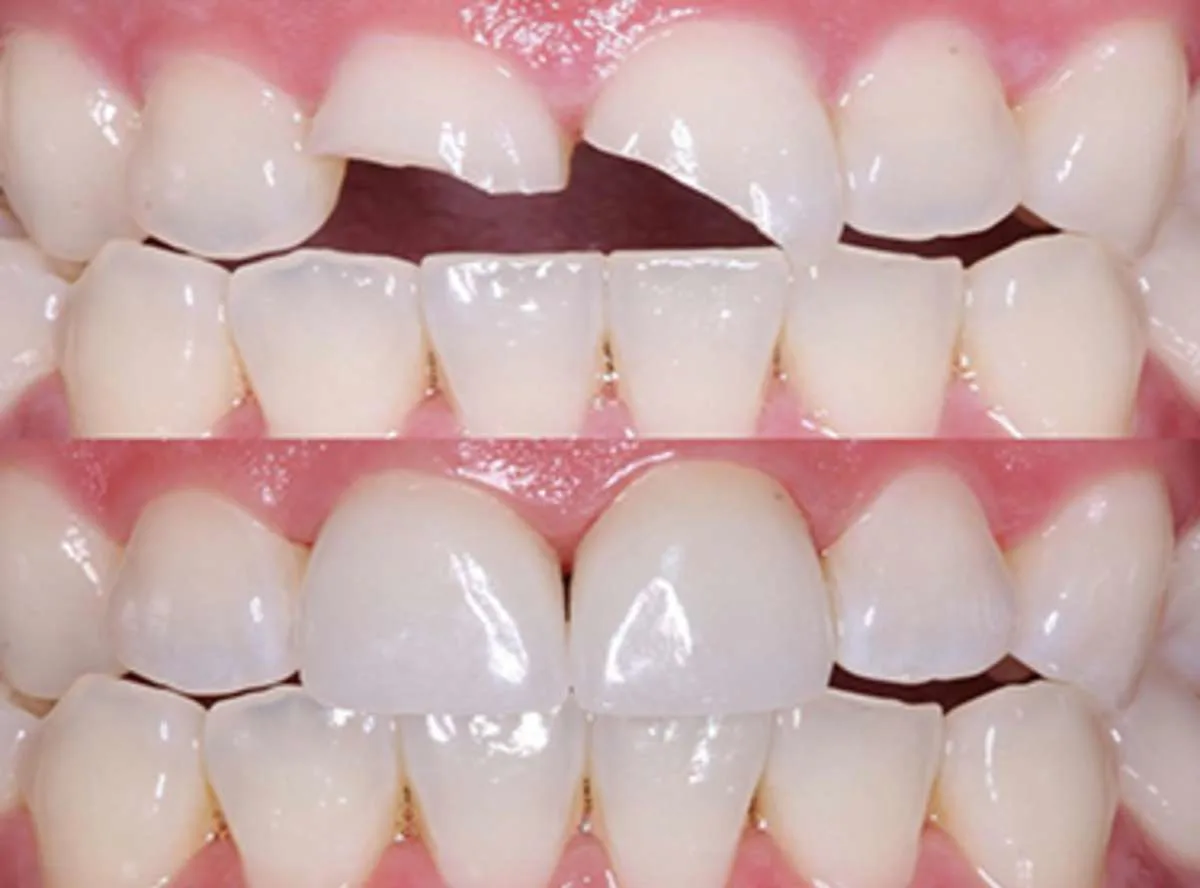 Fractured Tooth Treatment